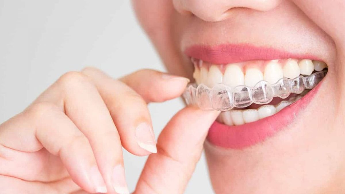 What is Invisalign? A Beginner's Guide to Clear Aligners