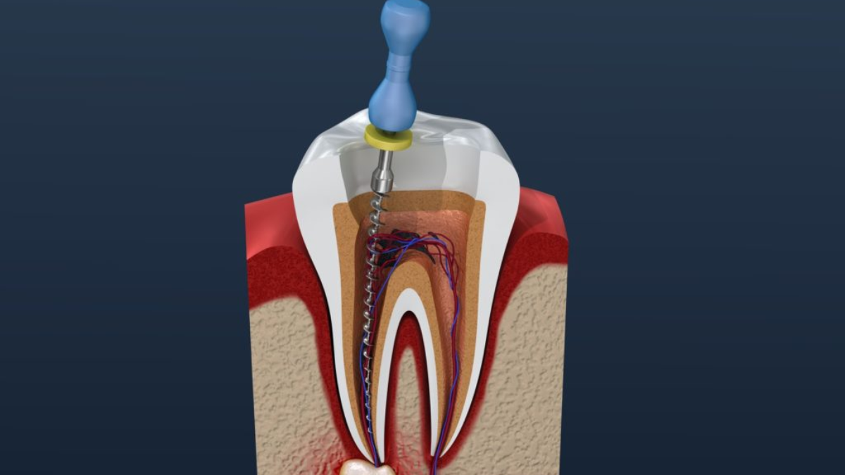 Things You Should Know Before Undergoing the Root Canal Procedure