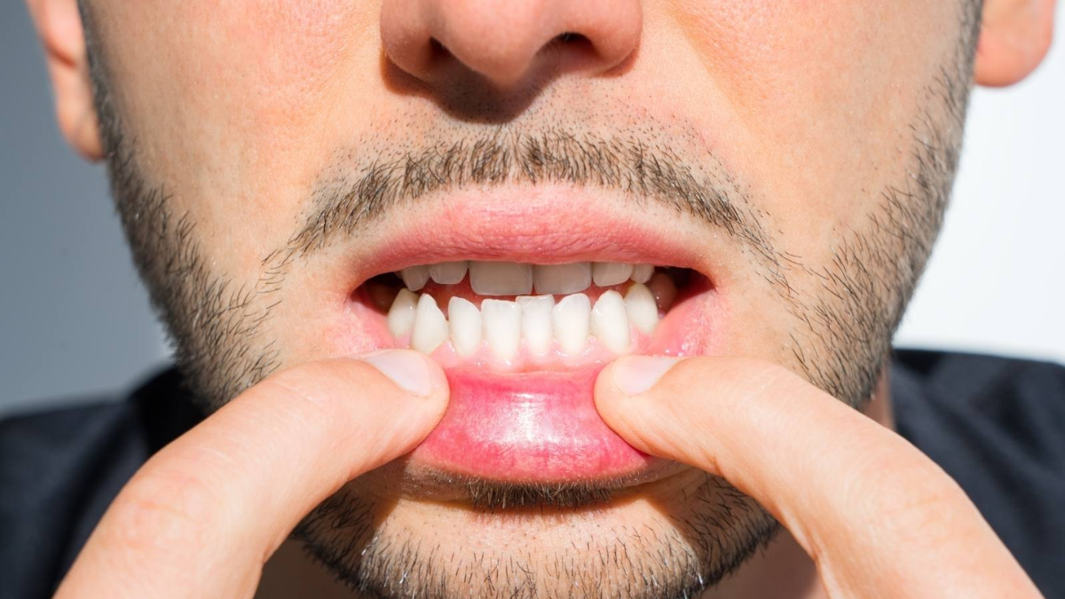 How Dietary Habits Affect Teeth Alignment 