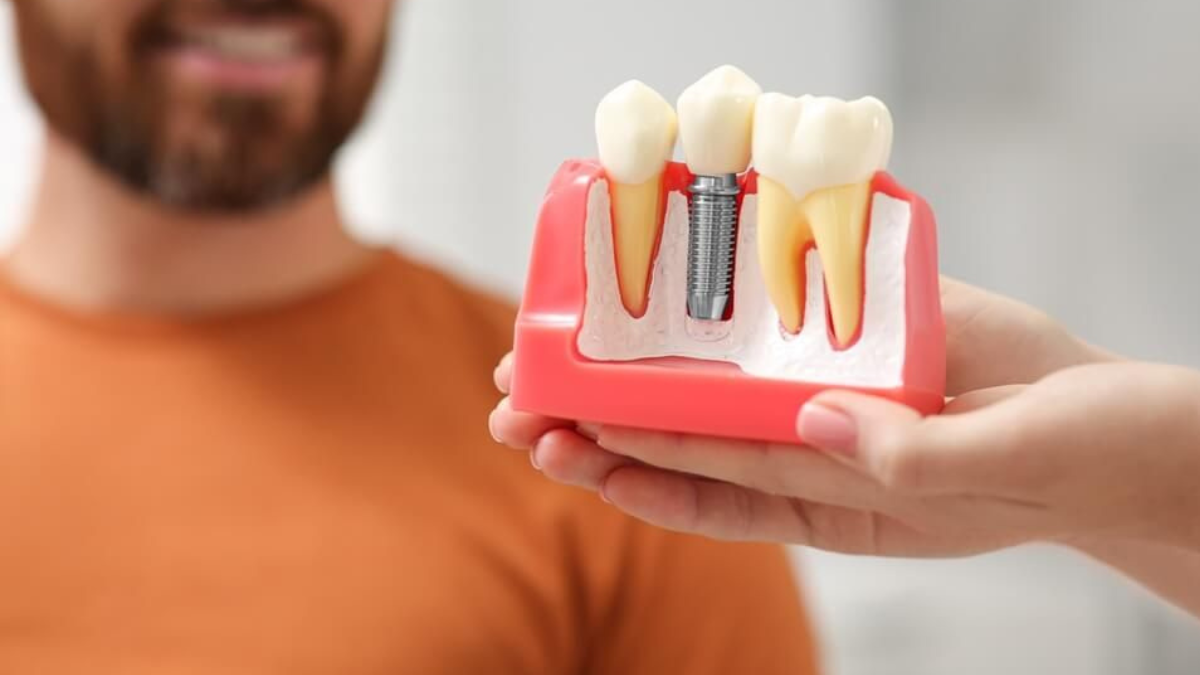 Are Dental Implants Removable Like Dentures or Do They Stay in Your Mouth? 