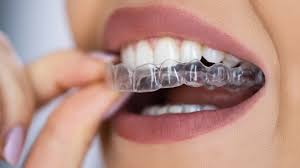 INVISALIGN Aligners: A Clear Path to a Confident Smile