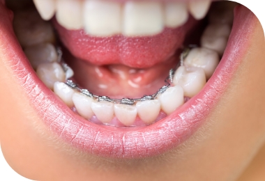 Features of Deep Bite