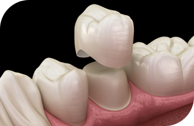 Dental Crowns