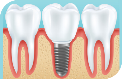 Dental Implants