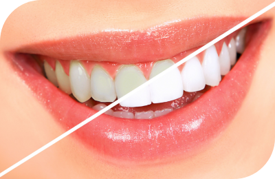 What is Smile Designing?